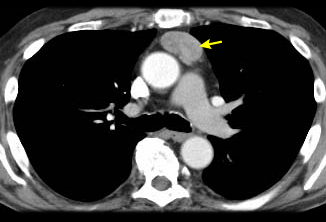 Thymic tumor images