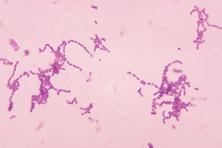 Sepsis in children images
