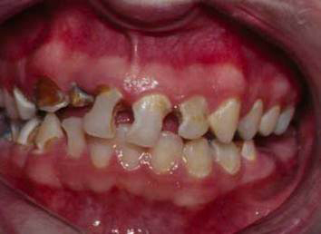 Dental abscess images