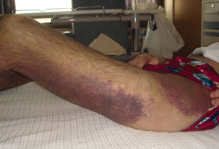 Evaluation of easy bruising images
