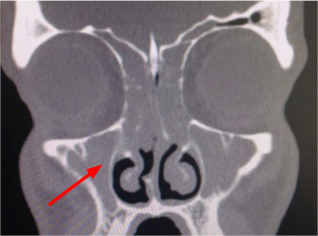Upper airway cough syndrome images
