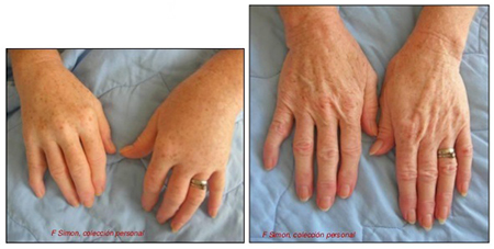 Chikungunya virus infection images