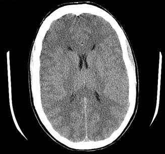 Hypernatremia images