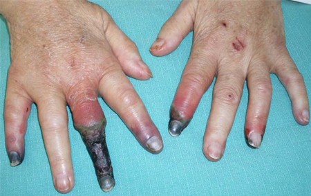 Hepatitis C images