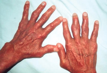 Gout images