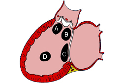 Congenital heart disease images