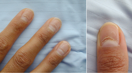 Hypoparathyroidism images