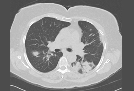 Organising pneumonia images