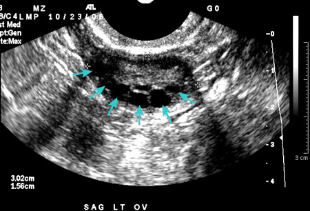 Polycystic ovary syndrome images