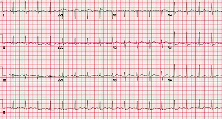 Chronic coronary disease images