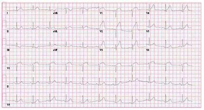 ST-elevation myocardial infarction images