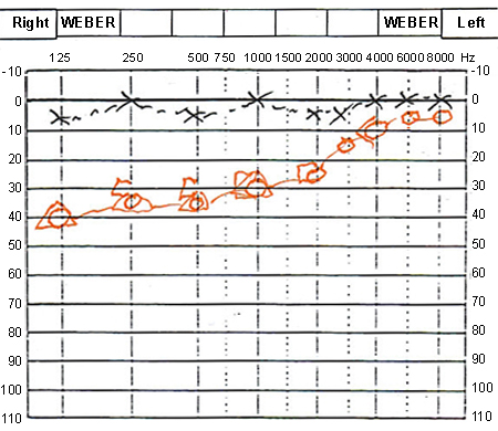 Meniere disease images