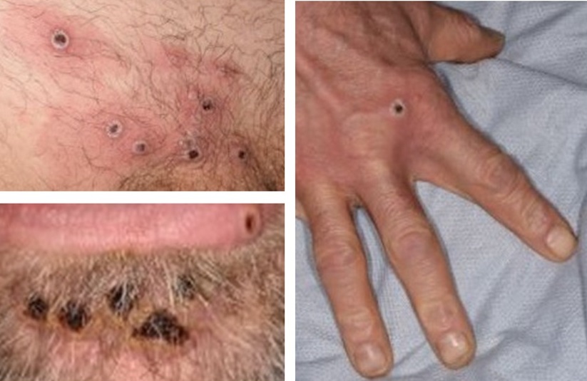 Mpox images