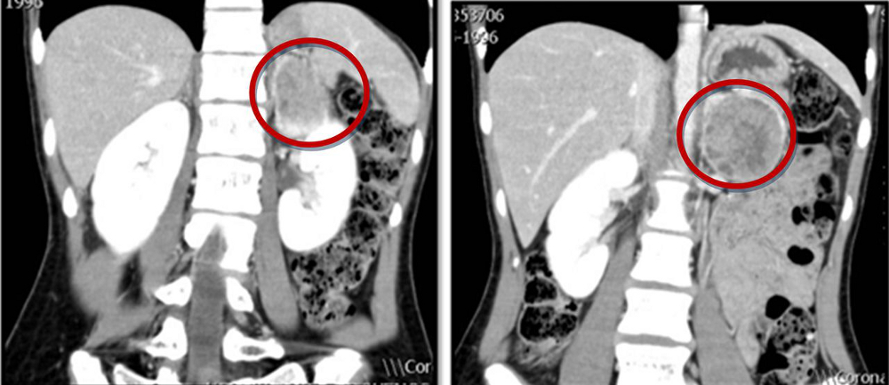 Phaeochromocytoma images