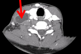 Tuberculose extrapulmonar images