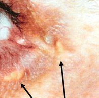 Hypercholesterolaemia images
