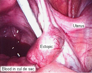 Ectopic pregnancy images