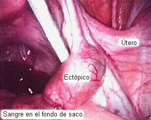 Embarazo ectópico images