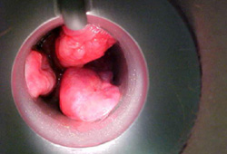 Hemorrhoids images