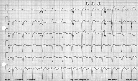 Focal atrial tachycardia images