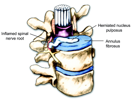 Evaluation of back pain images