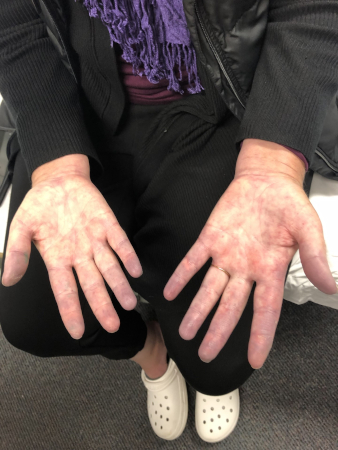Raynaud's phenomenon images