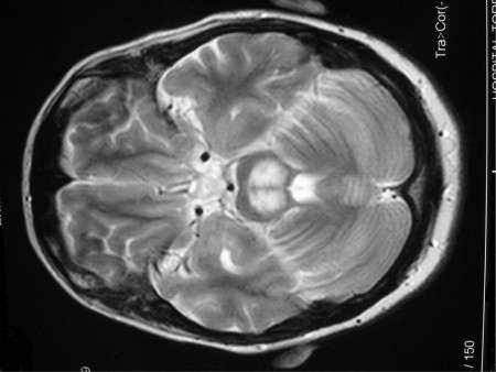 Syndrome of inappropriate antidiuretic hormone images