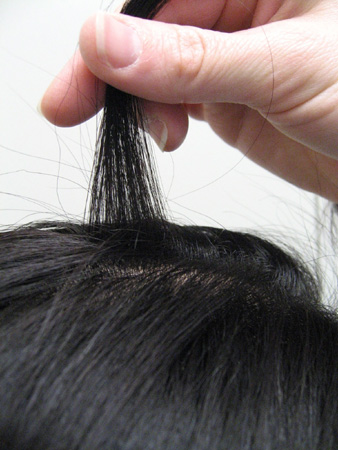 Androgenetic alopecia images