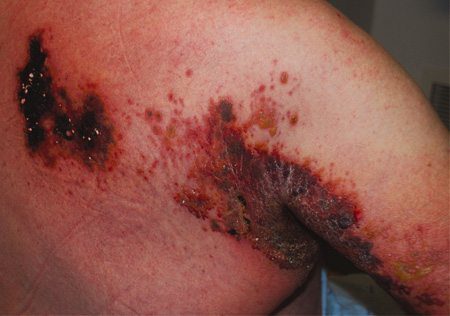 Herpes zoster infection images
