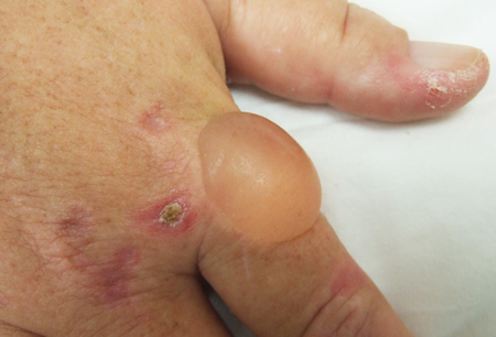 Porphyria cutanea tarda images