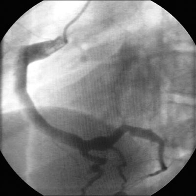 Kawasaki disease images