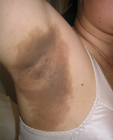 Type 2 diabetes mellitus in adults images