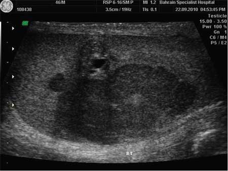 Testicular cancer images