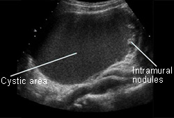 Ovarian cancer images