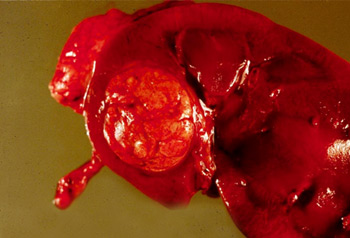 Renal cell carcinoma images