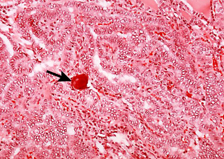 Câncer de tireoide images