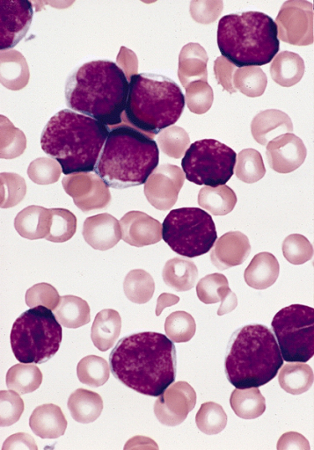 Acute lymphoblastic leukaemia images