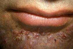 Folliculitis images