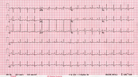 Idiopathic pulmonary arterial hypertension images