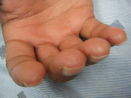 Systemic sclerosis (scleroderma) images