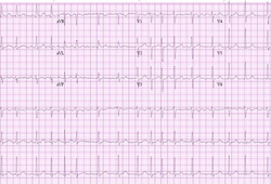New-onset atrial fibrillation images