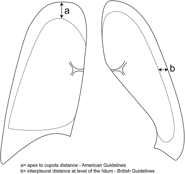 UK guidelines advise using the level of the hilum to measure the size of a pneumothorax. However, other countries may use other methods; for example US guidelines use the distance from the lung apex to the cupola, but this method would tend to overestimate the volume of a localised apical pneumothorax.