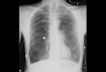 Anterior-posterior chest x-ray demonstrating a right pneumothorax