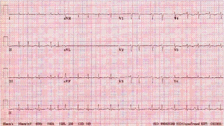 Multifocal atrial tachycardia