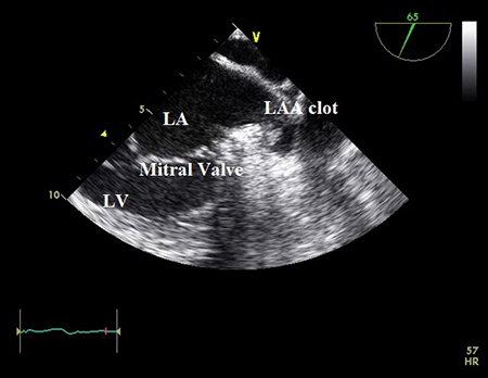 Transoesophageal echocardiogram showing left atrial appendage clot. LA, left atrium; LAA, left atrial appendage; LV, left ventricle