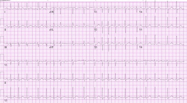 New-onset atrial fibrillation images