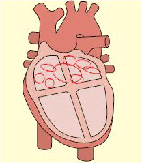 Múltiples ondas de fibrilación auricular compiten entre sí en la aurícula y bombardean el nódulo auriculoventricular con muchas señales.