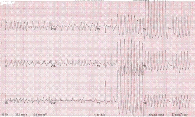 Fibrilación auricular con síndrome de Wolff-Parkinson-White