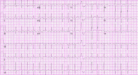 Flutter atrial
