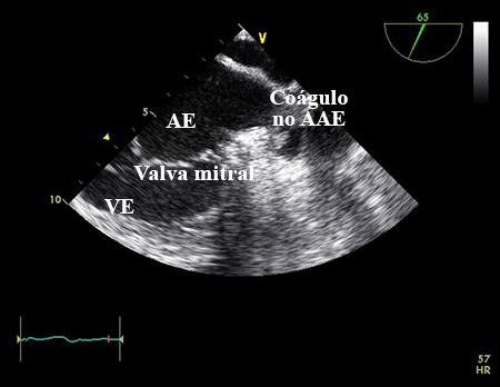 Ecocardiografia transesofágica mostrando coágulo no apêndice atrial esquerdo. AE, átrio esquerdo; AAE, apêndice atrial esquerdo; VE, ventrículo esquerdo